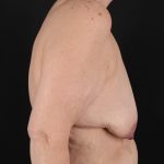 Breast Reduction with Lift Before & After Patient #3007