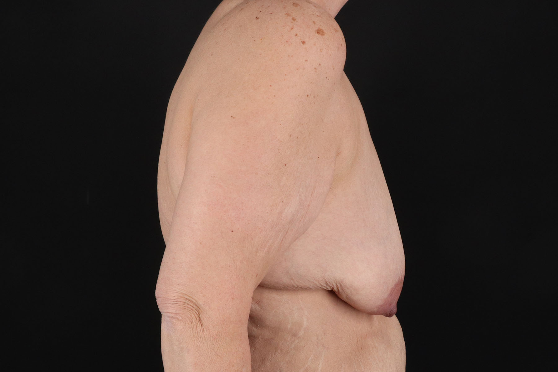 Breast Reduction with Lift Before & After Patient #3007