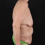 Breast Reduction with Lift Before & After Patient #3007