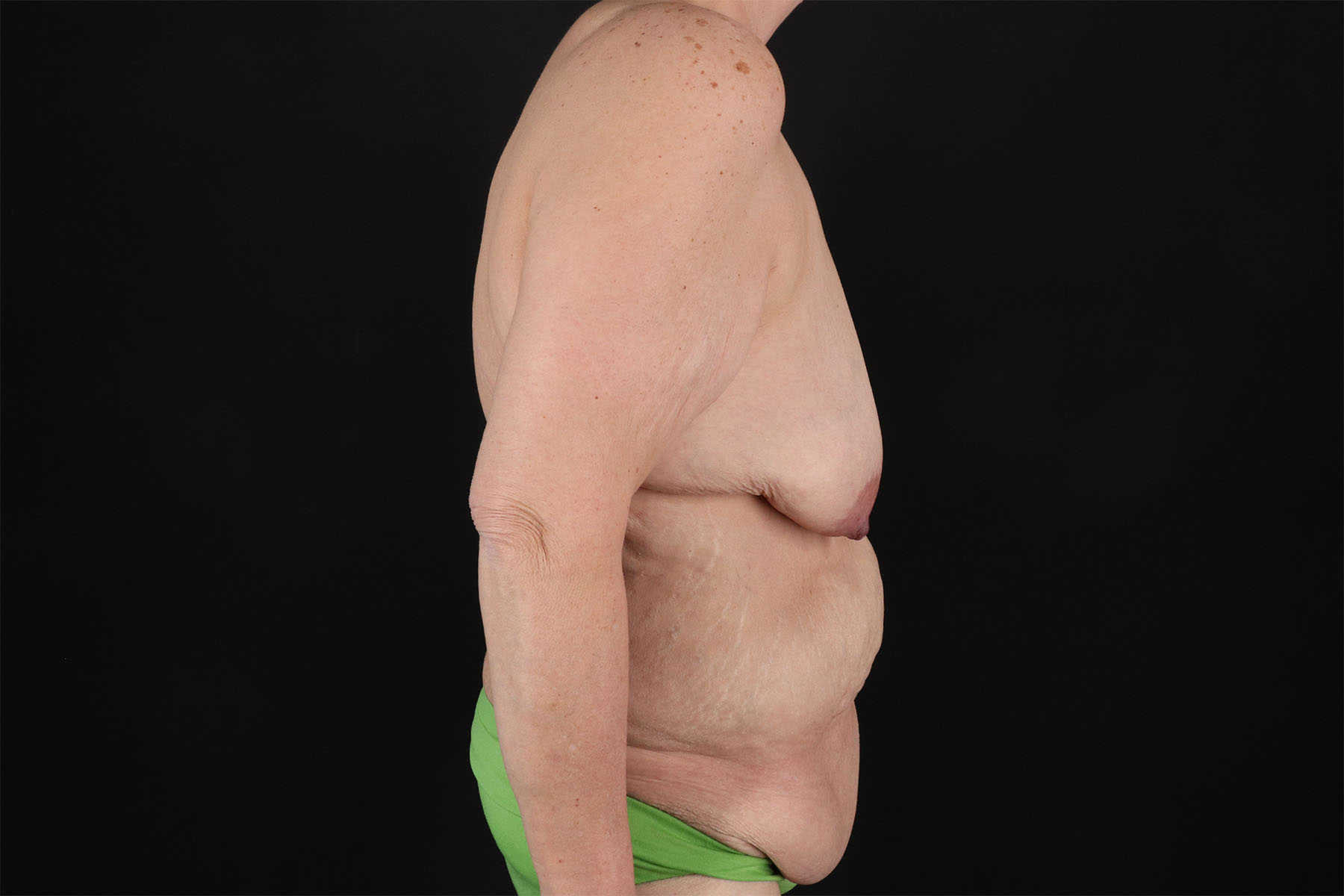 Breast Reduction with Lift Before & After Patient #3007