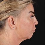 Neck Lift Before & After Patient #3476