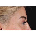 Eyelid Surgery Before & After Patient #3475