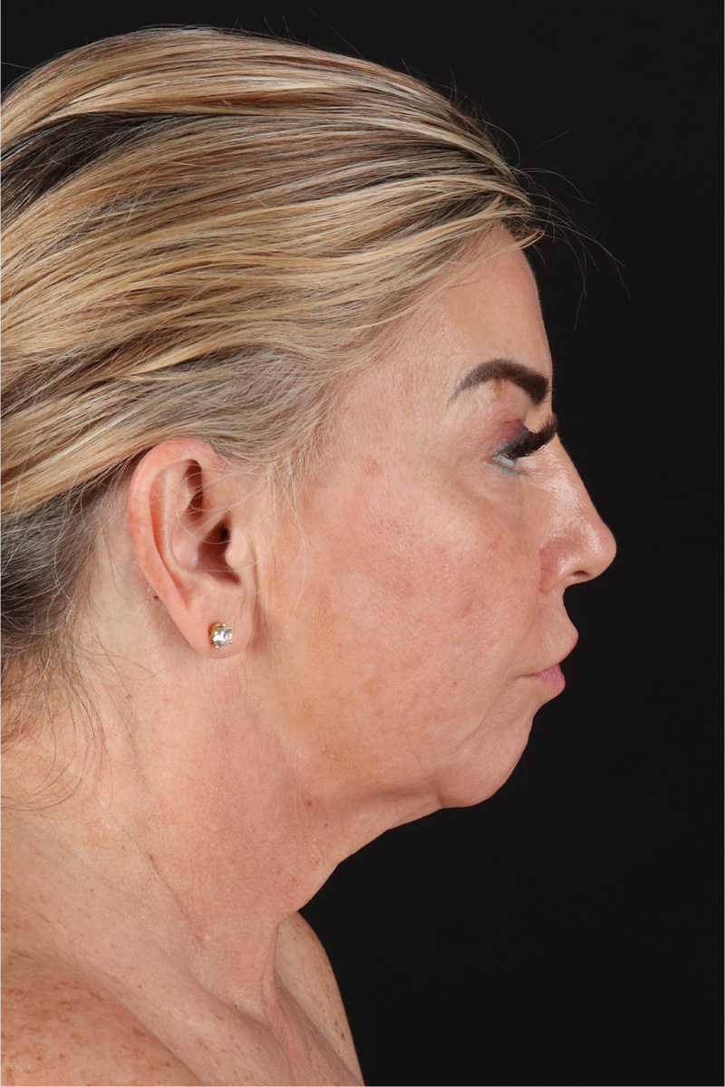 Neck Lift Before & After Patient #3476