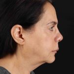 Structural Fat Grafting Before & After Patient #3645