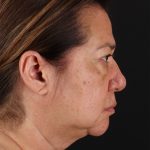 CO2 Laser Before & After Patient #3009