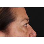 Eyelid Surgery Before & After Patient #3008