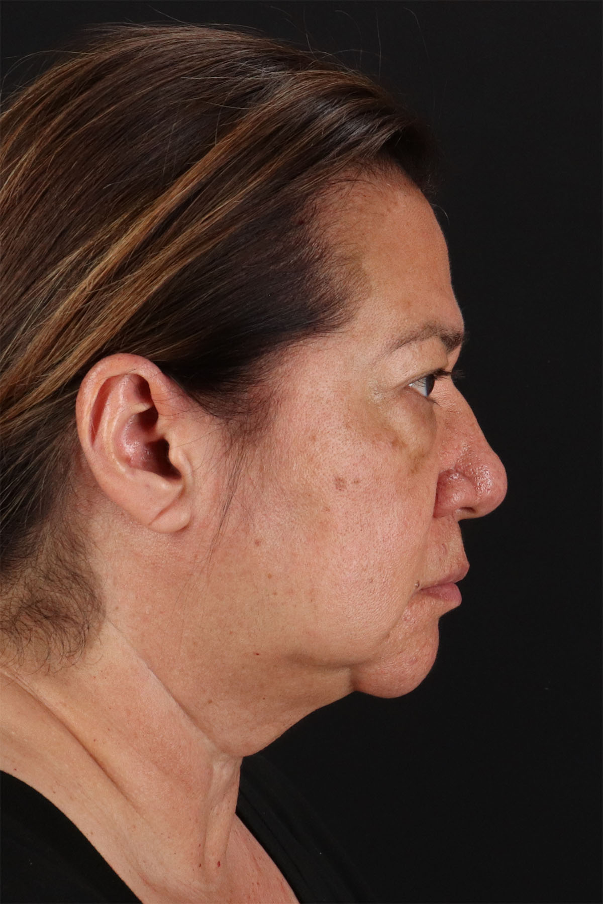 CO2 Laser Before & After Patient #3009