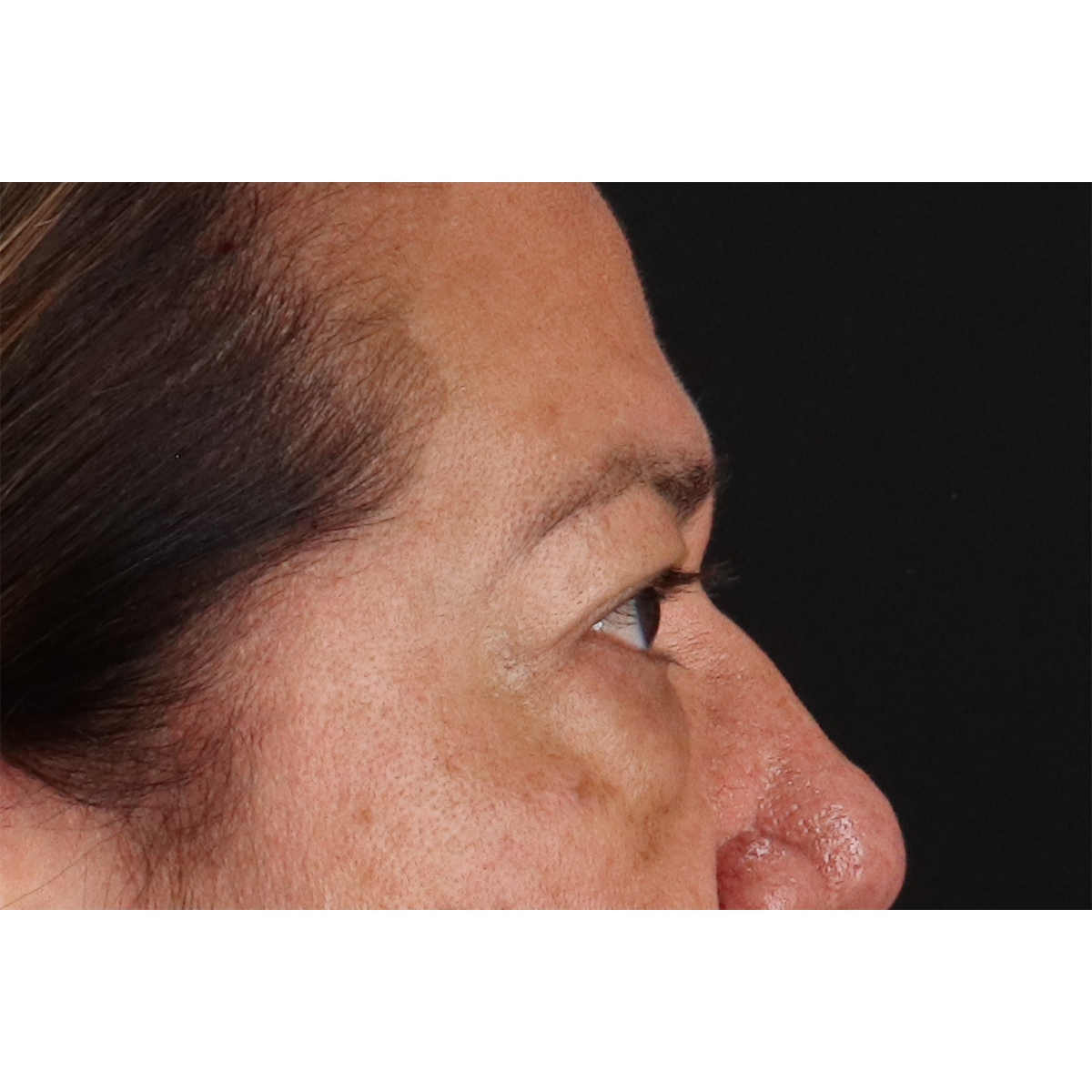 Eyelid Surgery Before & After Patient #3008