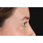 Eyelid Surgery Before & After Patient #3570
