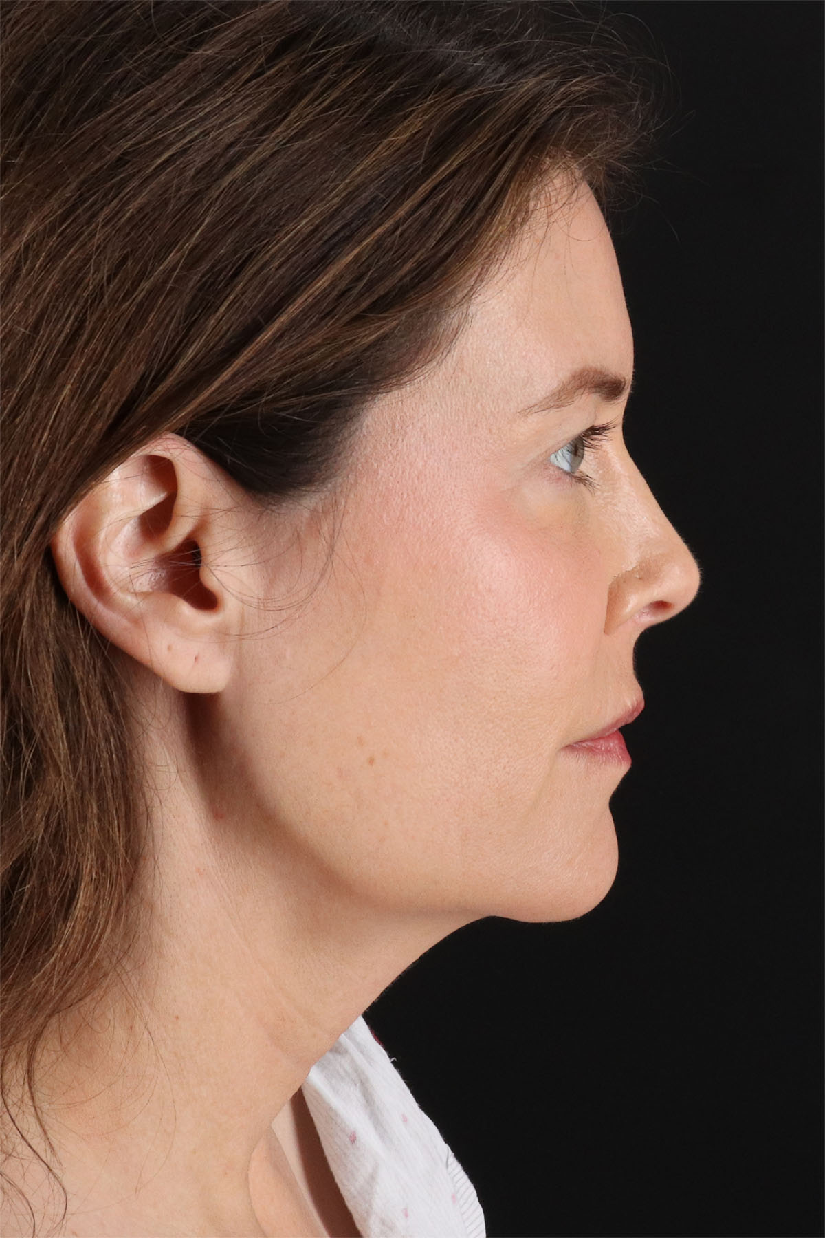 Structural Fat Grafting Before & After Patient #3647
