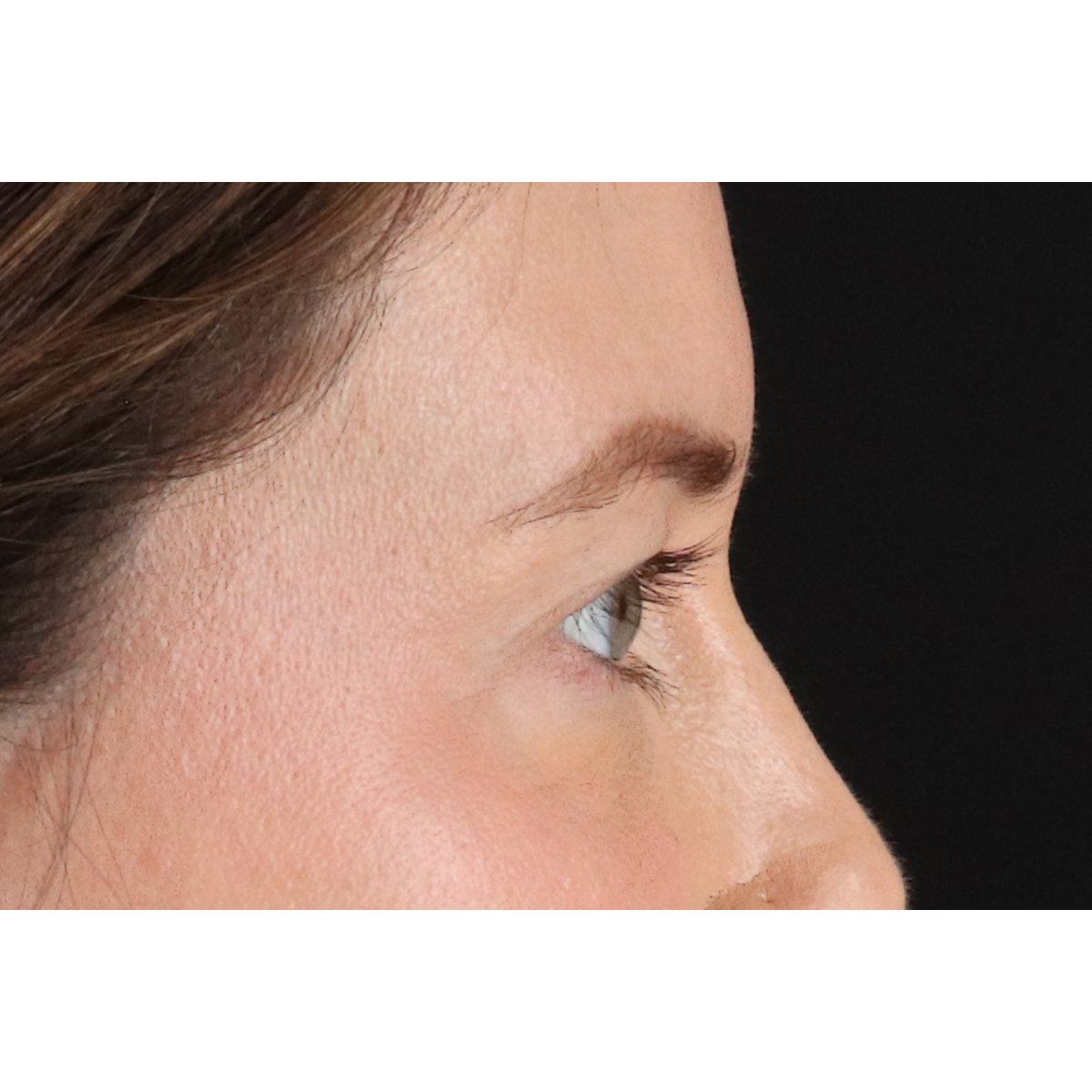 Eyelid Surgery Before & After Patient #3570