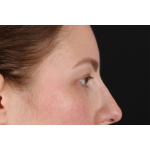 Brow Lift Before & After Patient #3111