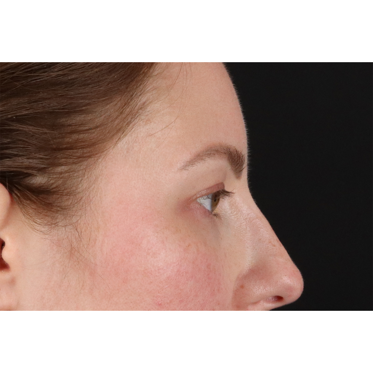 Brow Lift Before & After Patient #3111