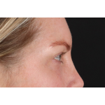 Eyelid Surgery Before & After Patient #3112