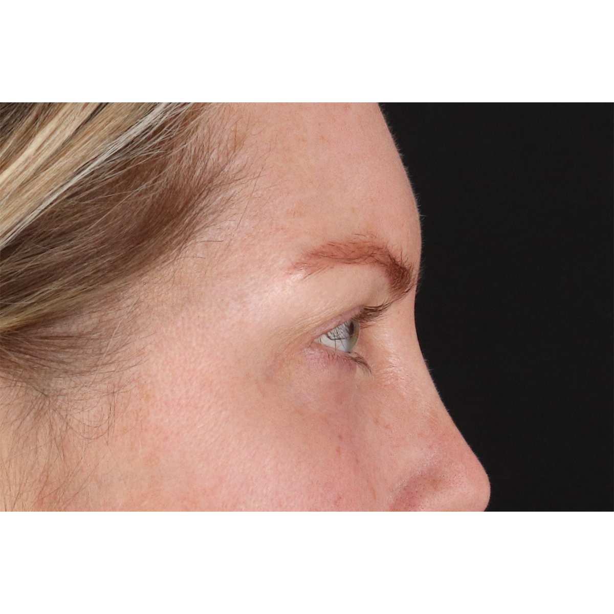Eyelid Surgery Before & After Patient #3112