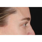 Eyelid Surgery Before & After Patient #3571