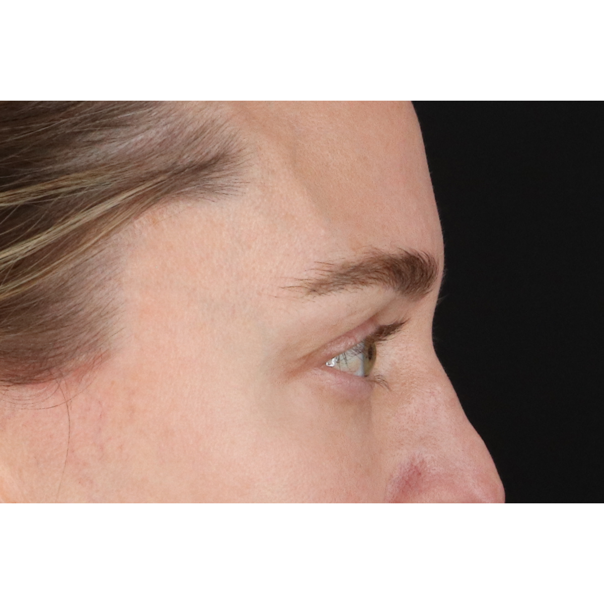 Eyelid Surgery Before & After Patient #3571