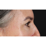 Eyelid Surgery Before & After Patient #3356