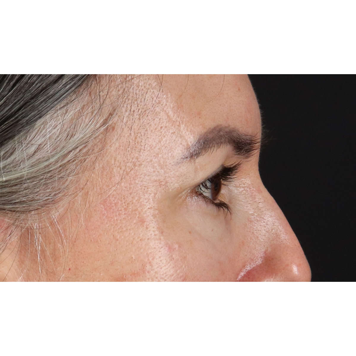 Eyelid Surgery Before & After Patient #3356