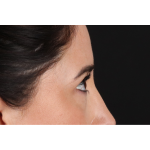 Eyelid Surgery Before & After Patient #3358