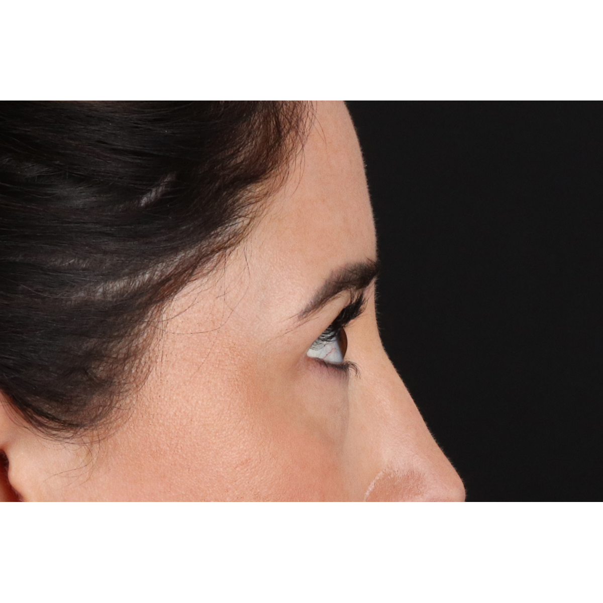 Eyelid Surgery Before & After Patient #3358