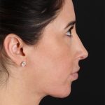 Structural Fat Grafting Before & After Patient #3649