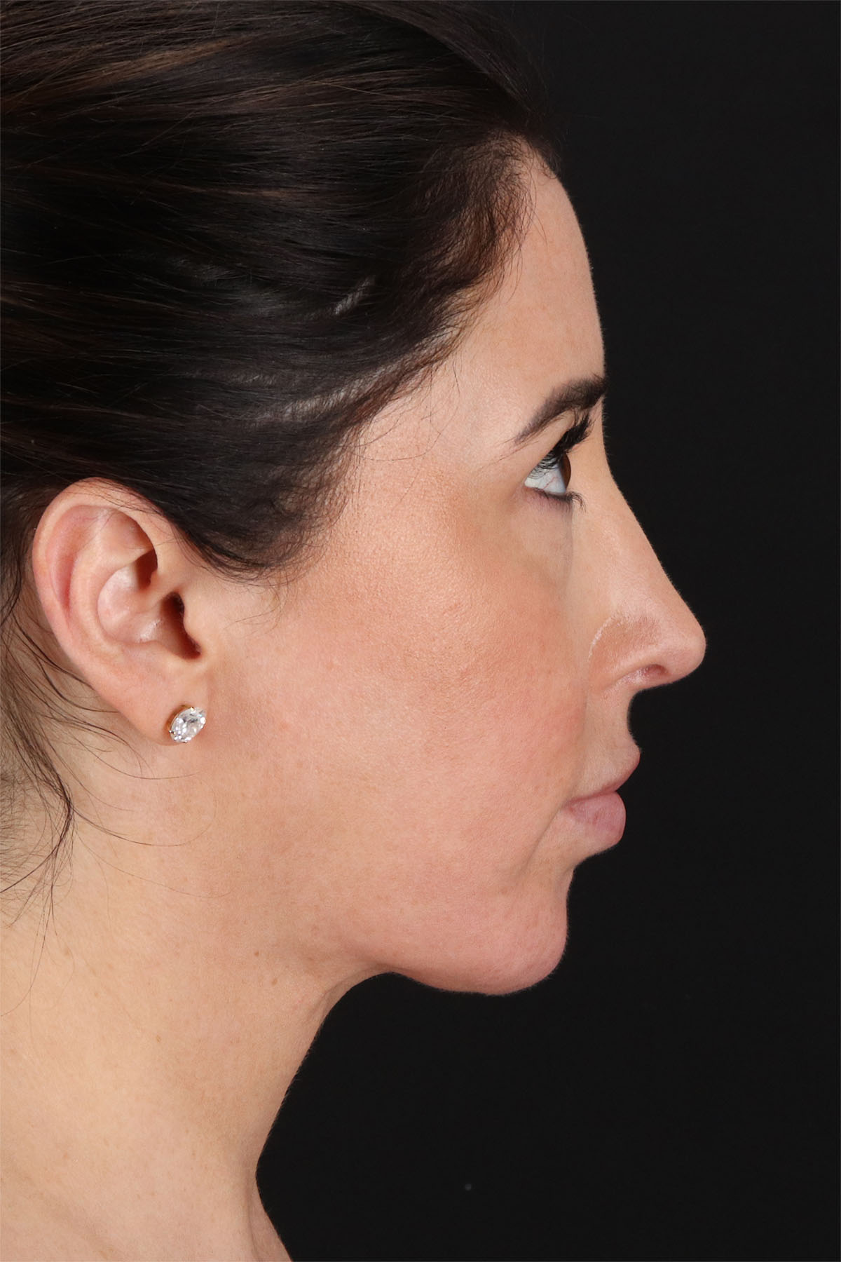 Structural Fat Grafting Before & After Patient #3649