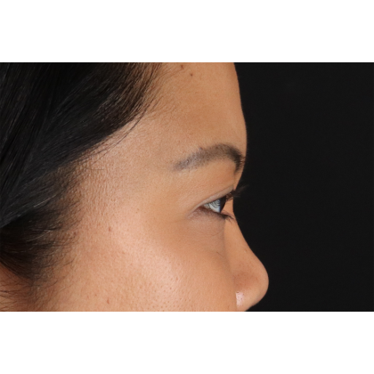 Brow Lift Before & After Patient #3114