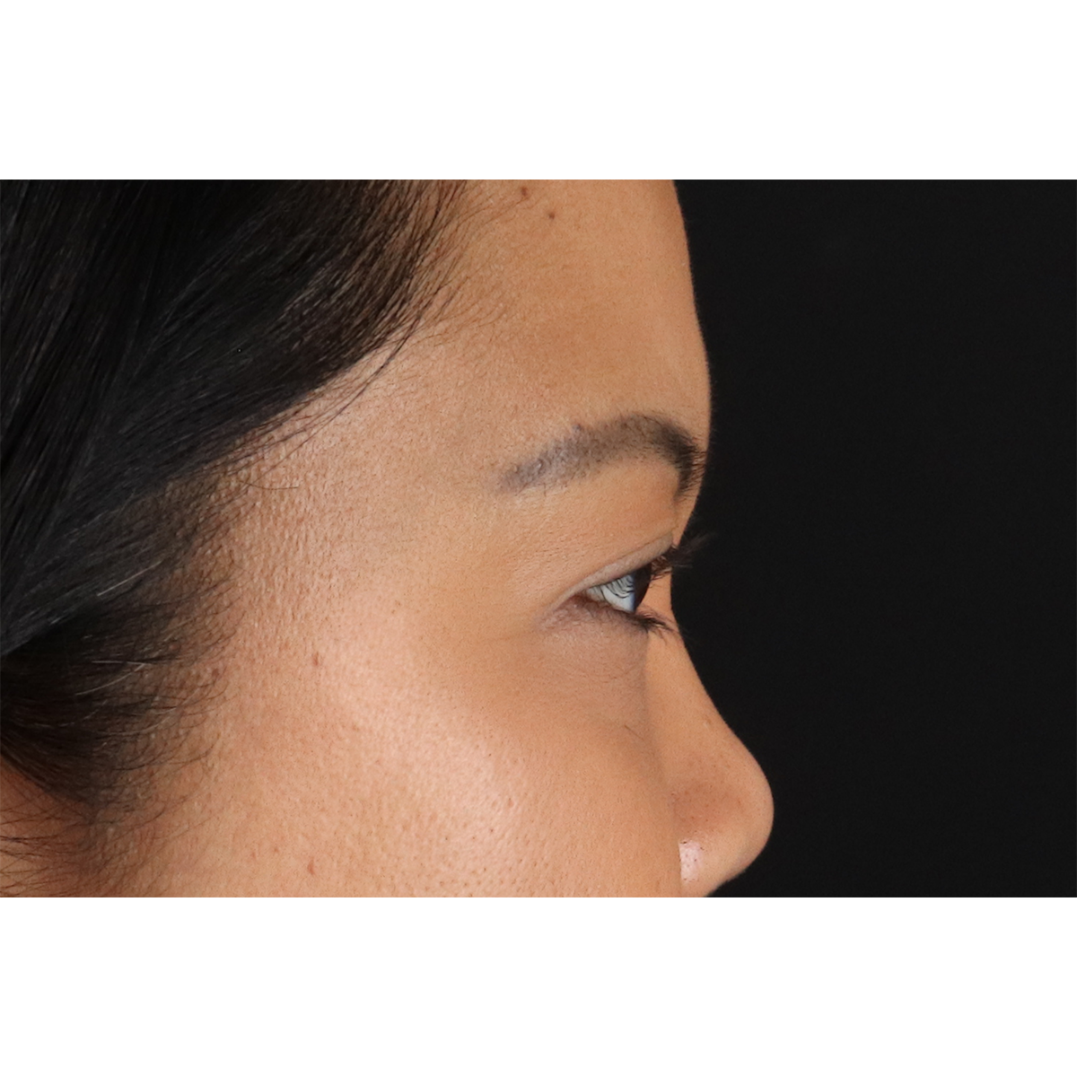 Brow Lift Before & After Patient #3114