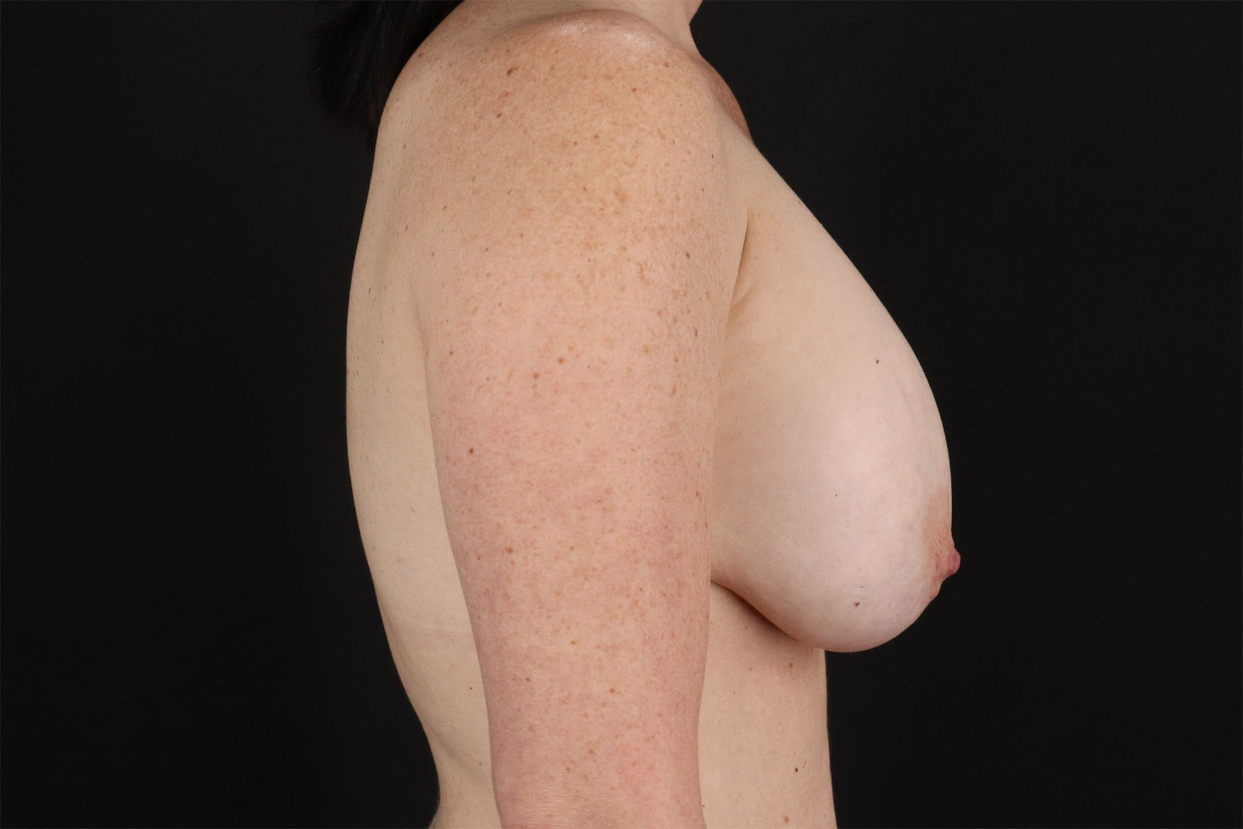 Breast Lift Before & After Patient #3115