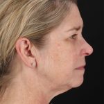CO2 Laser Before & After Patient #3116