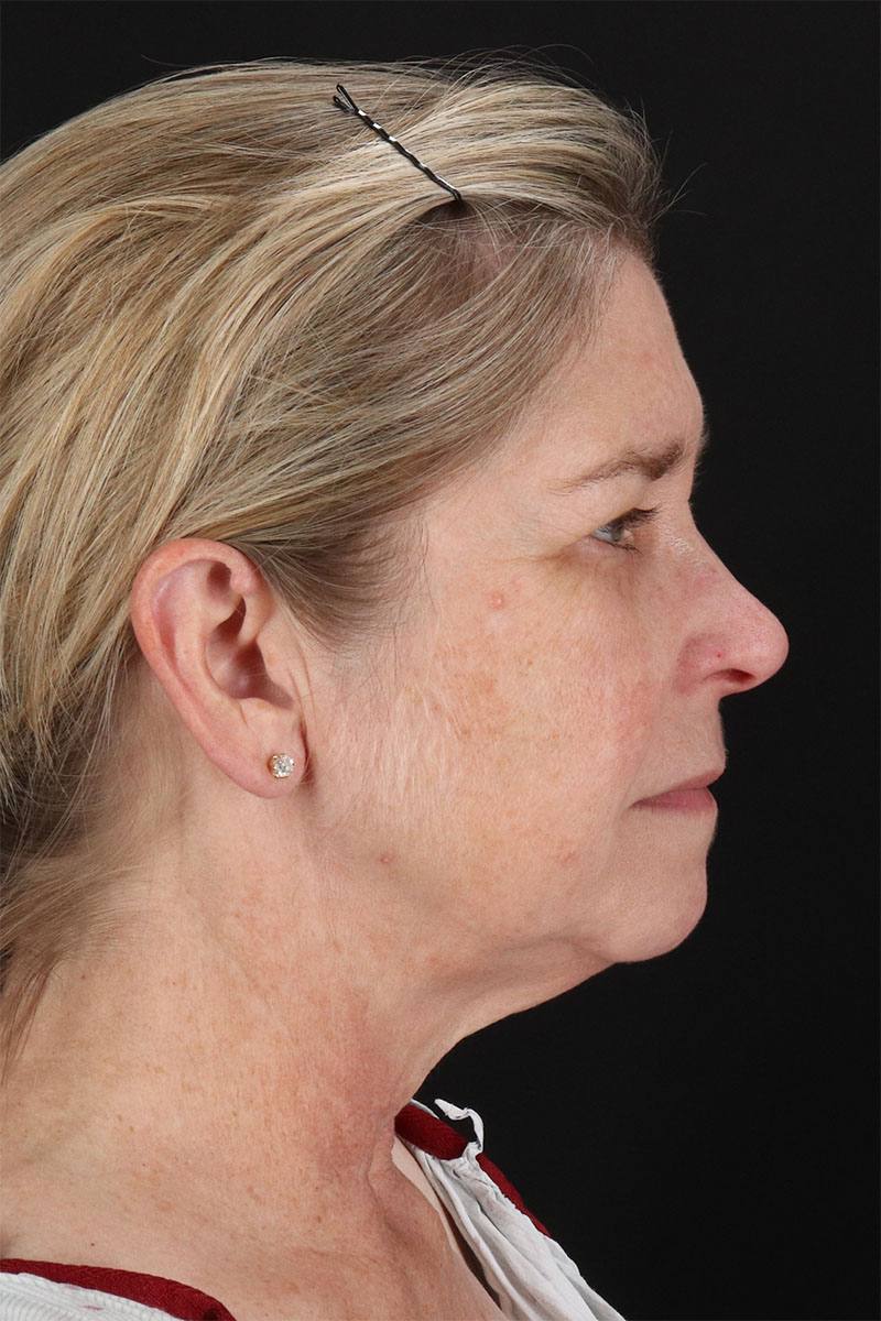 CO2 Laser Before & After Patient #3116