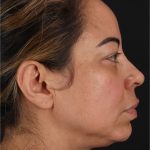Laser Before & After Patient #3359