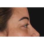 Eyelid Surgery Before & After Patient #3360