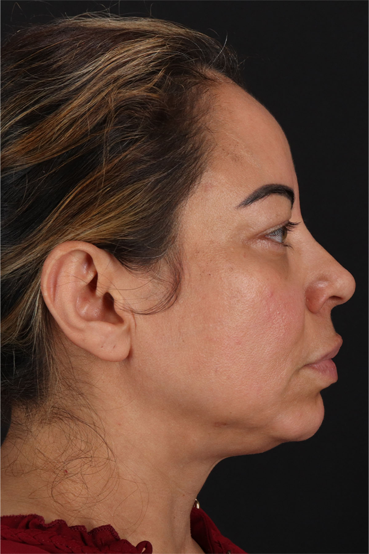 Laser Before & After Patient #3359
