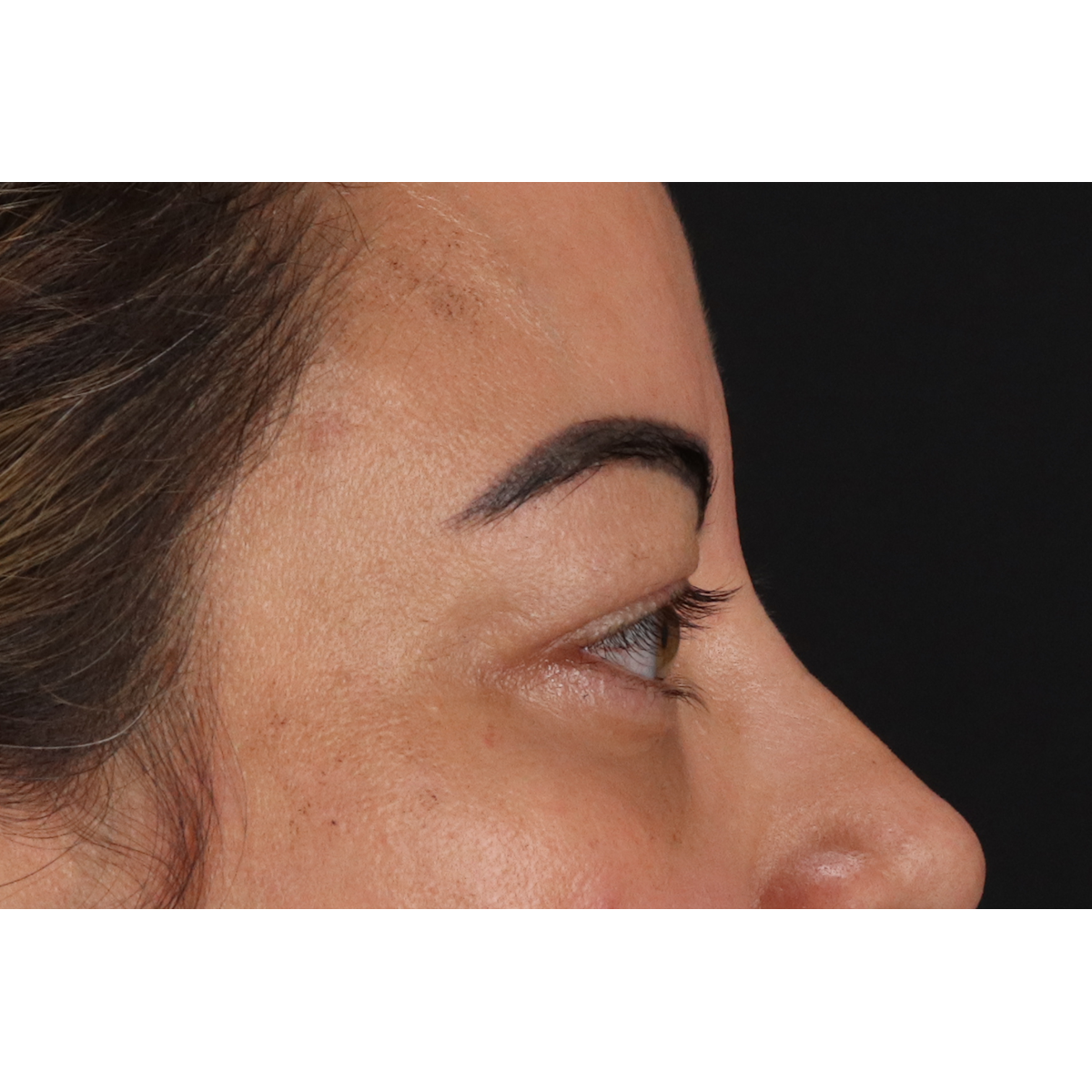 Eyelid Surgery Before & After Patient #3360