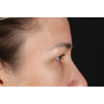 Eyelid Surgery Before & After Patient #3361