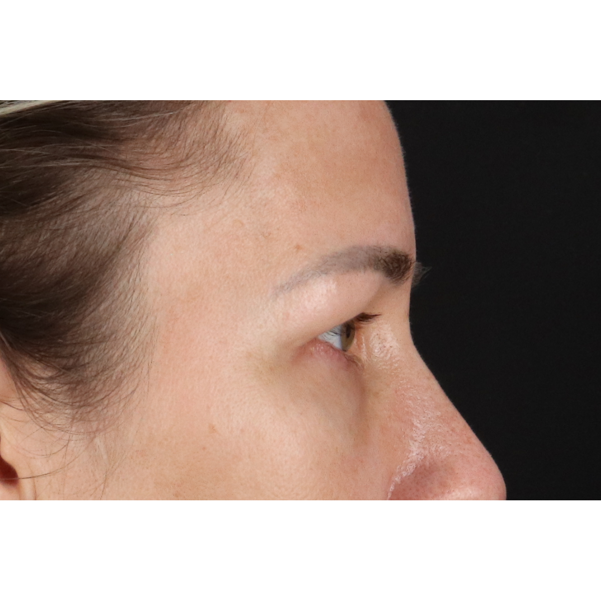 Eyelid Surgery Before & After Patient #3361
