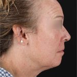 Laser Before & After Patient #3362