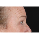 Eyelid Surgery Before & After Patient #3363