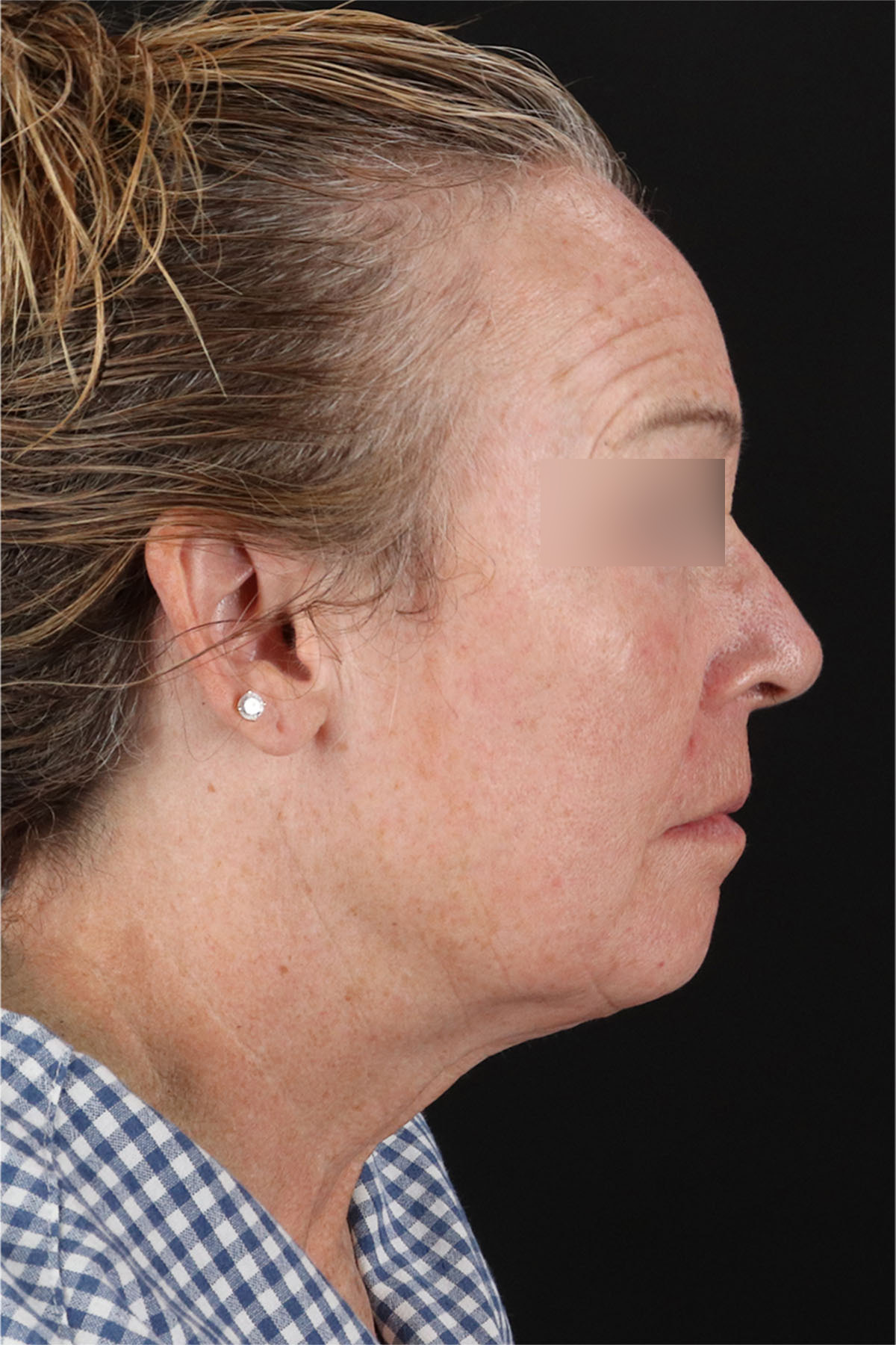 Laser Before & After Patient #3362