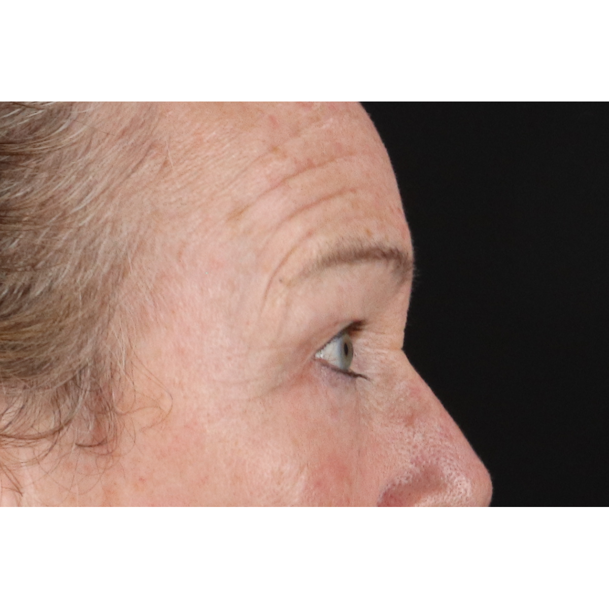 Eyelid Surgery Before & After Patient #3363