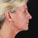 Ponytail Facelift Before & After Patient #3118