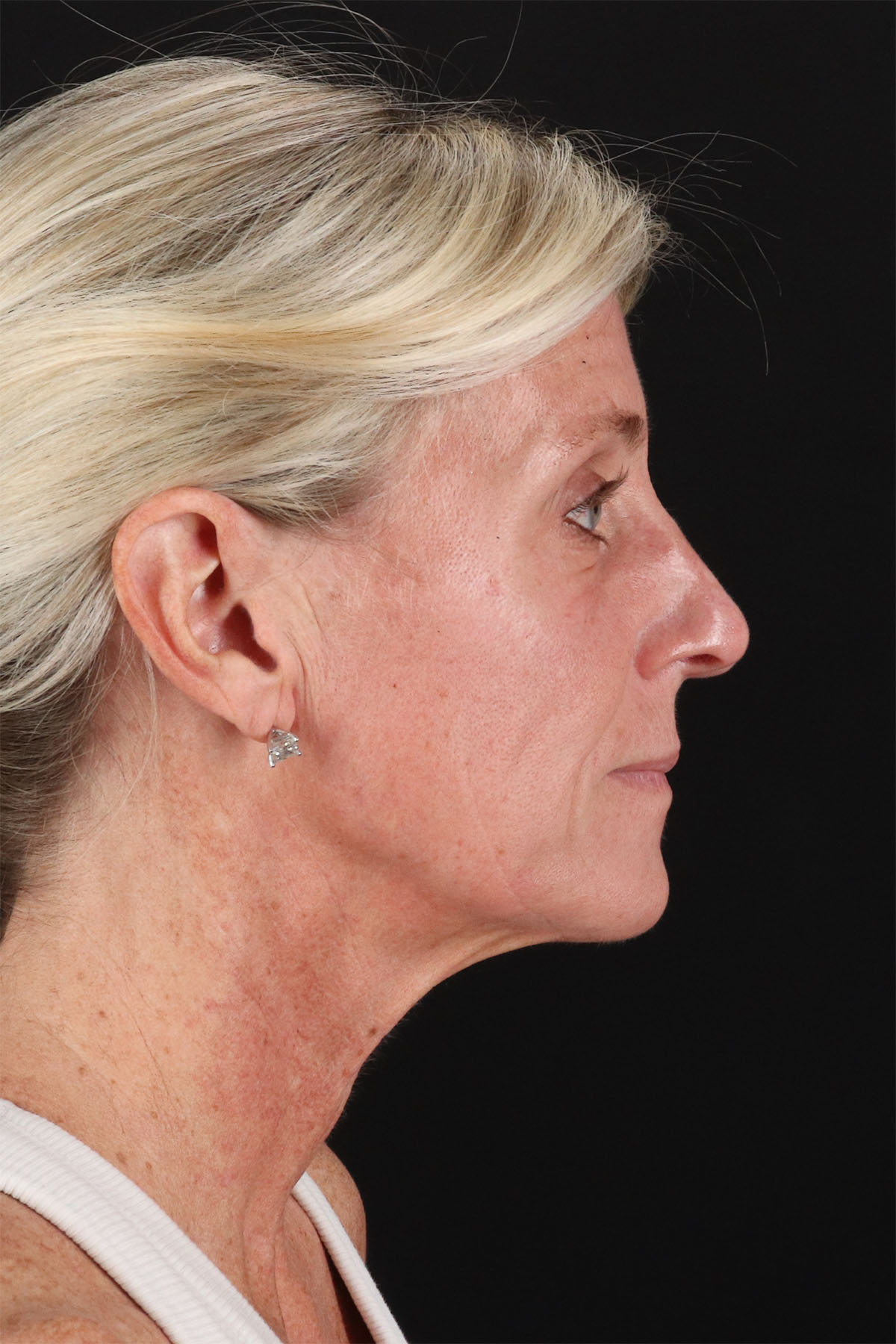 Ponytail Facelift Before & After Patient #3118