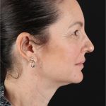 Chemical Peel Before & After Patient #3470