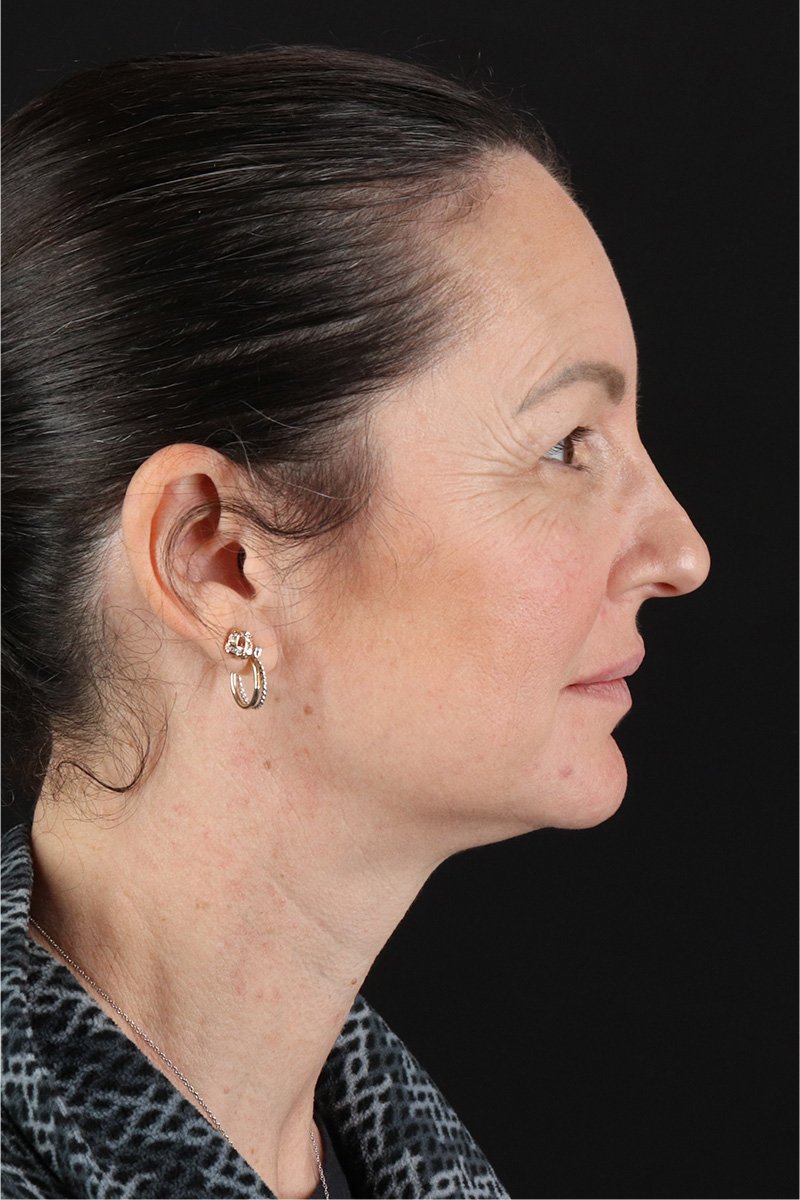 Chemical Peel Before & After Patient #3470