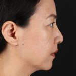 Skin Resurfacing / Laser Before & After Patient #3001