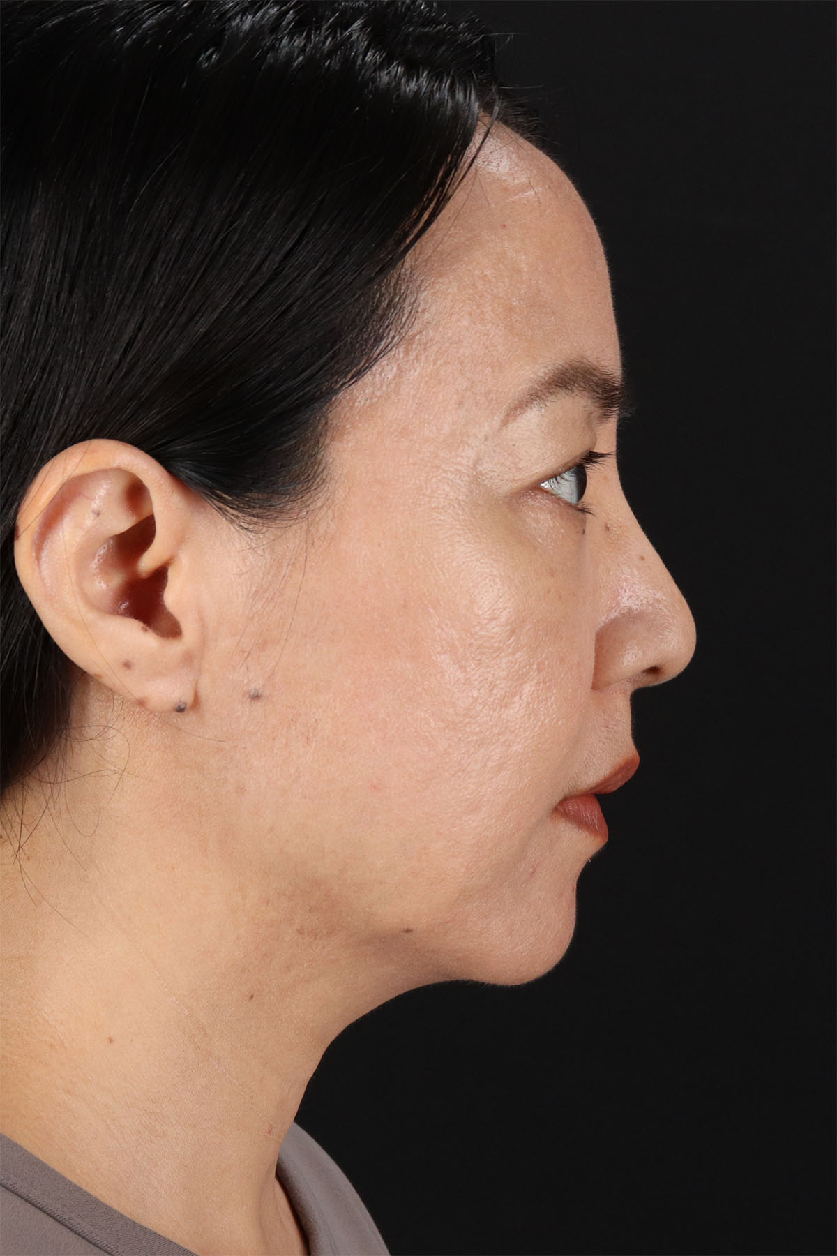 Skin Resurfacing / Laser Before & After Patient #3001