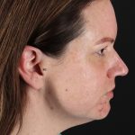 Chemical Peel Before & After Patient #3002