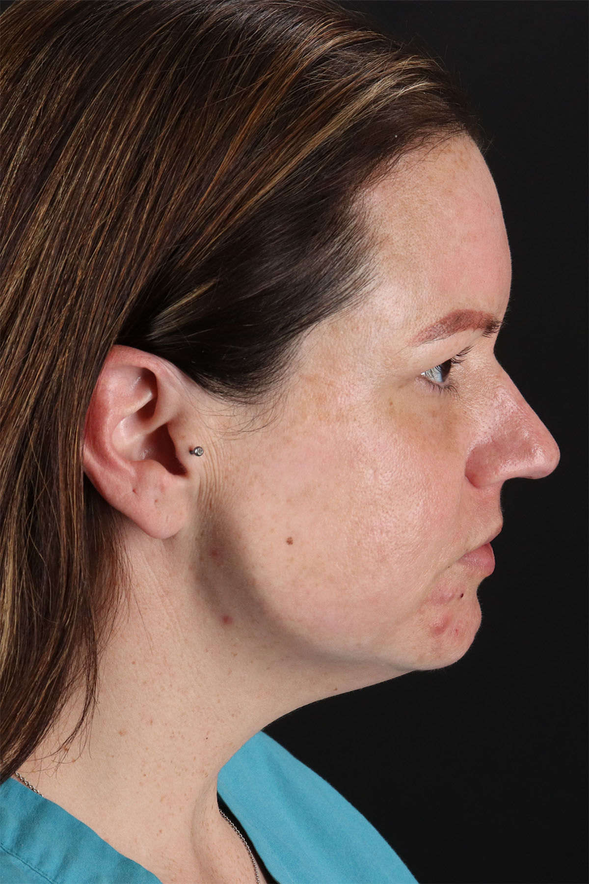 Chemical Peel Before & After Patient #3002